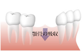 複数本の欠損歯