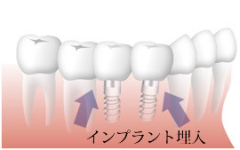 複数本の欠損歯